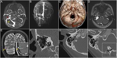 Case Report: Venous pulsatile tinnitus induced by enlarged oblique occipital sinus and resultant diverticulum/dehiscence of the sigmoid-jugular wall